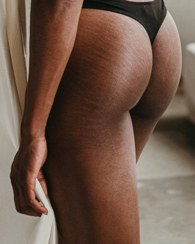 butt with stretch marks
